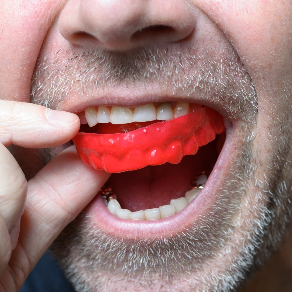Man placing a red bite plate in his mouth to protect his teeth at night from grinding caused by bruxism close up view of his hand and the appliance